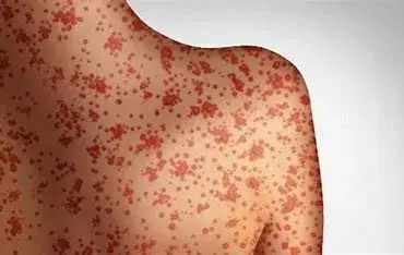 Measles-Unmasked